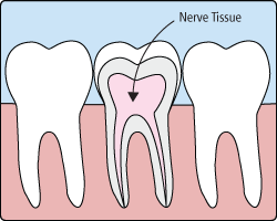 root-canals